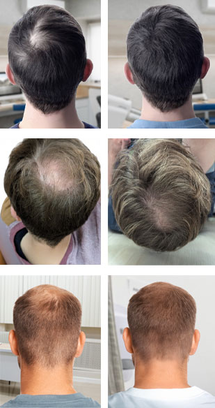 Men's PRP Hair Loss Treatment near Boston MA