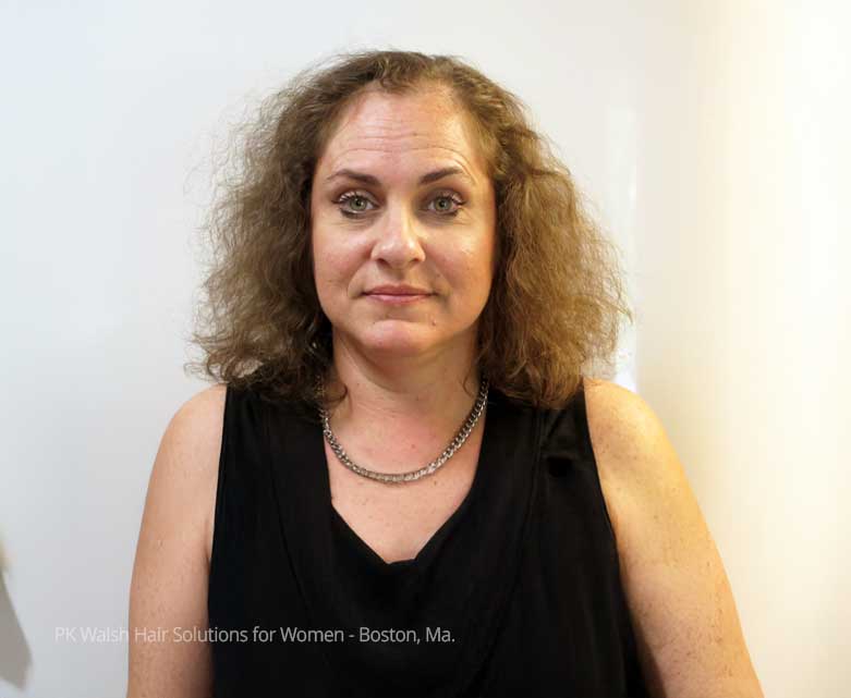 Before and after photos of women’s non-surgical hair replacement showing restored fullness and natural-looking results at PK Walsh in Greater Boston.