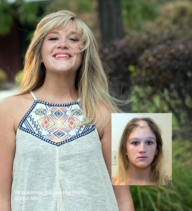 Womens hair replacement PK Walsh Boston MA