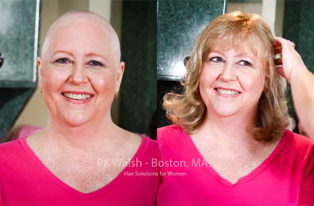 Providence Ri womens hair solutions for medical hair loss
