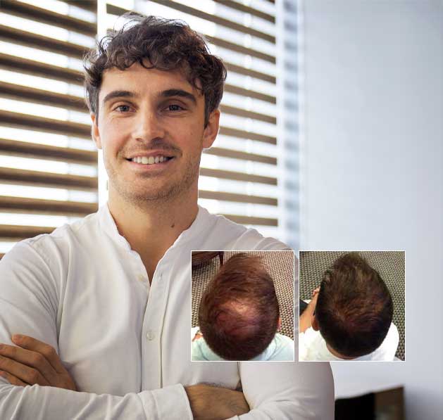 PRP hair loss treatment for men in Boston MA at PK Walsh Hair Solutions