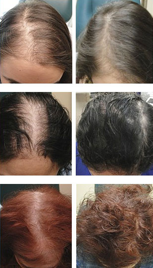 PRP hair loss treatment results at PK Walsh Hair Solutions for Women near Boston