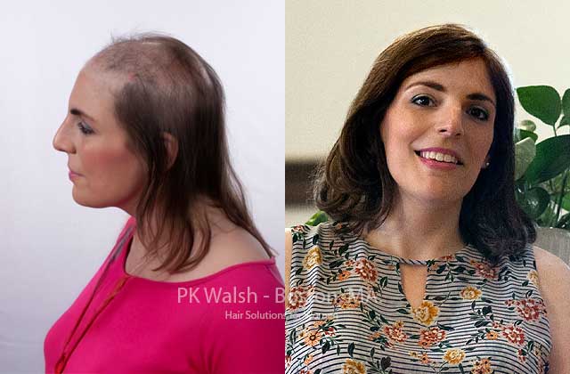 Totally natural looking women's hair replacement at PK Walsh Hair Solutions for Women