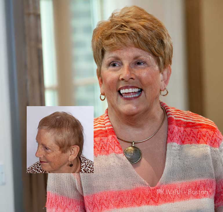 womens-hair-replacement-pk-walsh-boston-ma confidential hair loss solutions for Boston women
