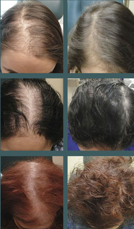 prp hair restoration boston ma pk walsh